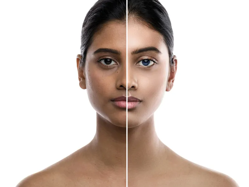 Dermal filler treatment